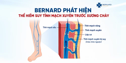 Bernard phát hiện thể hiếm suy tĩnh mạch xuyên trước xương chày: "Nguồn suy" âm thầm khiến nhiều người điều trị nhiều năm không khỏi